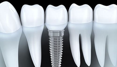 Illustration of a dental implant with a crown, placed between natural teeth